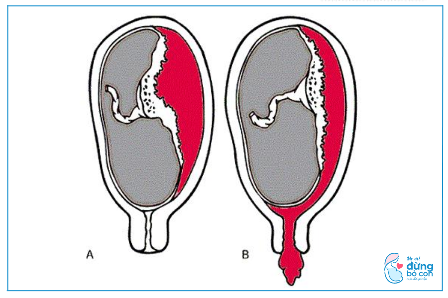 Phá Thai Tại Nhà Có Nguy Hiểm Không, Chị Em Cần Lưu Ý?